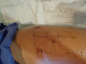 Incisions...... 3 to match on the other side, they say symmetry is beauty :)